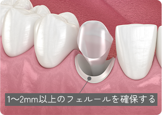 1～2mm以上のフェルールを確保する