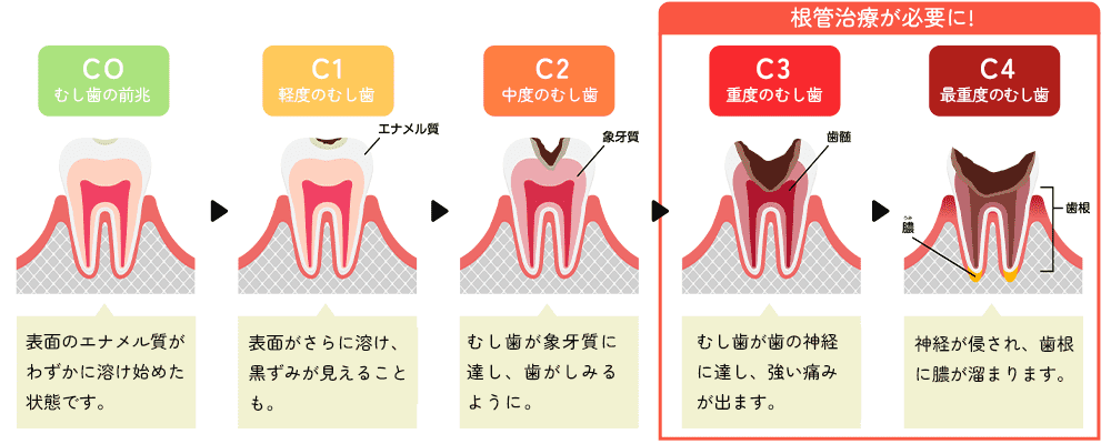 むし歯の進行度 C1~C5