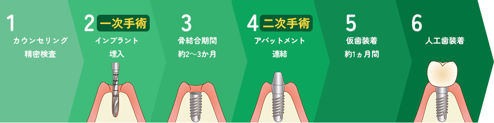 当院のインプラントの治療の流れ 2回法