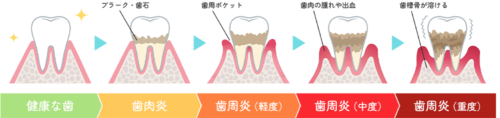 歯周病の進行